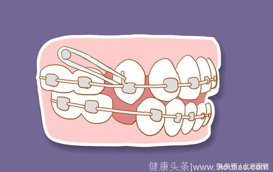 想变美又怕疼？这个“锅”牙套不背！这些正畸误区你中了几招？