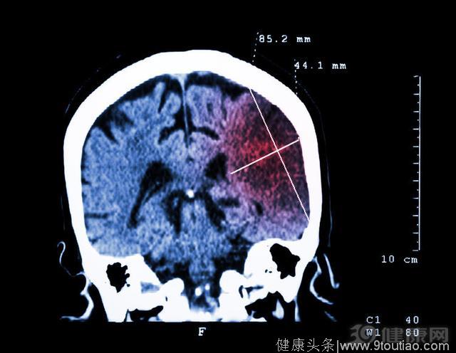 出现这几个症状，说明脑血管已经堵塞，很可能会脑梗！