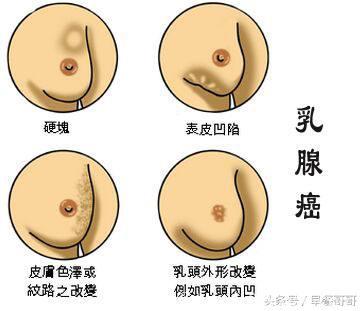 3分钟乳腺科普：乳腺增生和结节有什么区别？会发展为乳腺癌吗？
