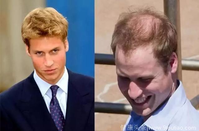 英国王室的遗传脱发，可能靠这把梳子就有救了……