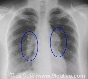 体检查出结节、囊肿、增生，哪个才是癌症的先兆？