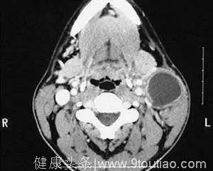 体检查出结节、囊肿、增生，哪个才是癌症的先兆？