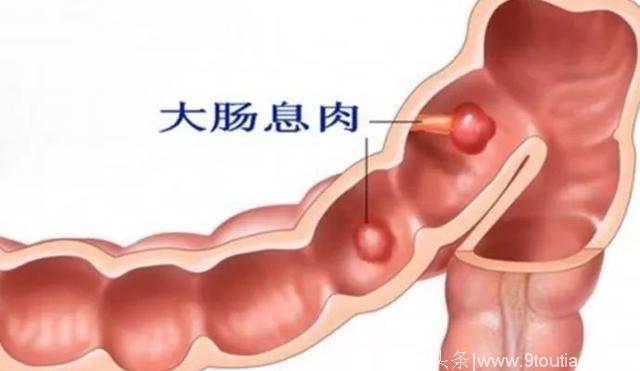 体检查出结节、囊肿、增生，哪个才是癌症的先兆？