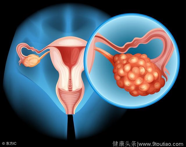 卵巢癌患者在饮食上该如何调理？推荐这3款食疗，不妨一试