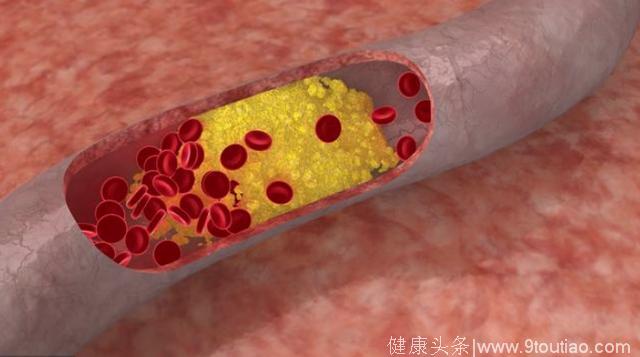 这3种食物吃一口，甘油三酯猛飚，常喝一种水，软化血管很简单