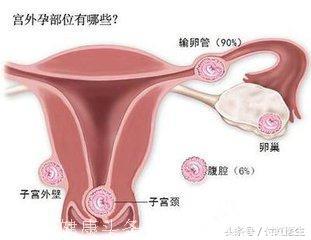 因为宫外孕切除了一根输卵管，还能怀孕吗？