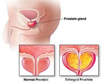 前列腺“增大”到底要不要治疗？
