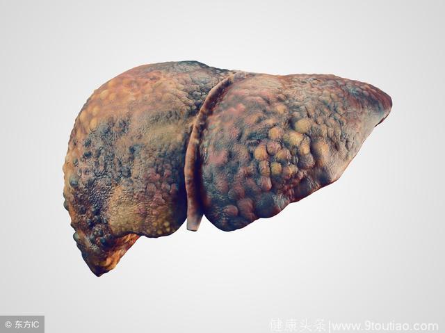 脂肪肝1年竟成肝硬化，医生给的忠告，值得所有脂肪肝患者看看