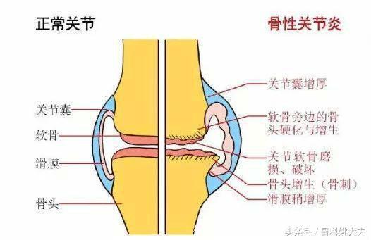 患有关节炎的大妈又得了骨刺和关节缝隙变窄，可把大妈吓坏了··