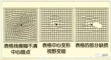 一张图测痴呆、脑梗、视力，50岁后每年都要测！