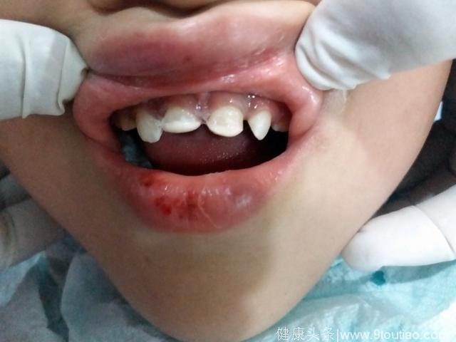 儿童牙齿意外受伤脱落或折断怎么办？友好小白兔口腔的专家告诉你
