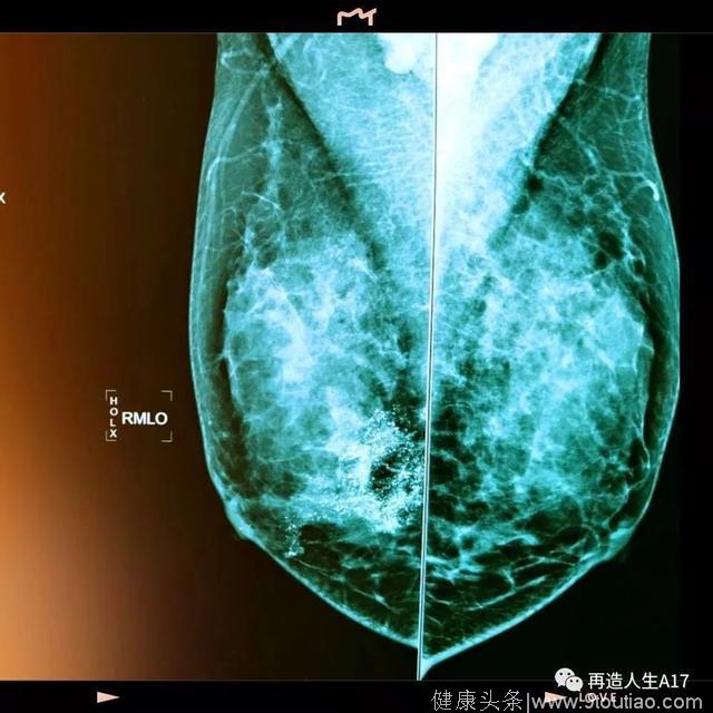 体检查出“乳腺增生”、“乳腺钙化”，我是不是要得癌了？