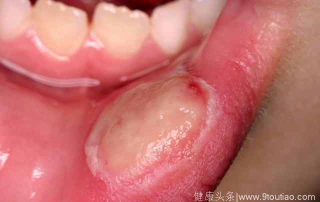 牙龈上有疙瘩溃疡是什么原因?