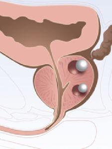 体检发现前列腺钙化，什么是前列腺钙化？怎么治疗呢？