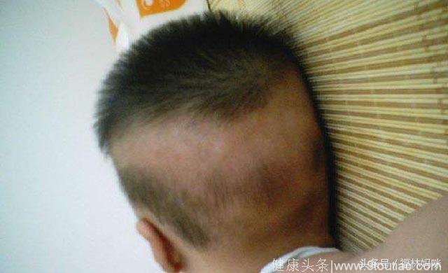 宝宝后脑头发稀疏，是枕枕头导致的？背后的原因还有这些！