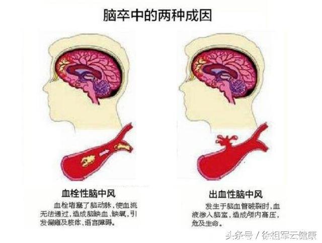 脑中风的康复：理疗食疗综合调理方案