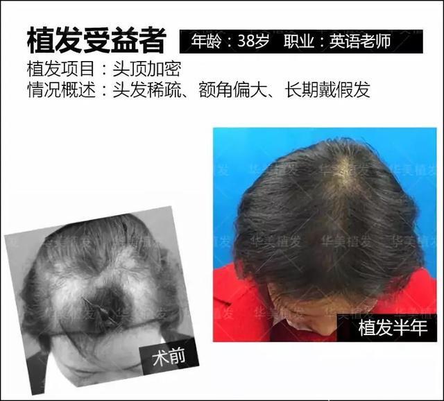 头发大把掉！头顶稀疏、脱发、秃顶……专家提醒：一定不要瞎治