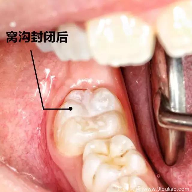 儿童龋齿丨涂氟和窝沟封闭到底哪个更管用？