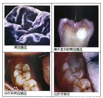 「微健康」反正小孩要换牙，有做窝沟封闭的必要吗？这几点家长不得不知道