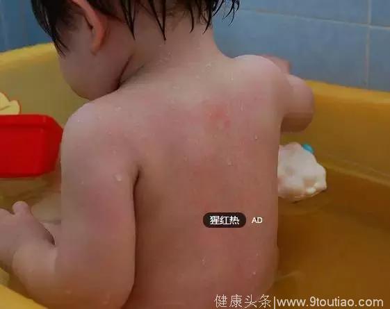 香港发出警报：传染病猩红热猖獗！广东也进入高发期