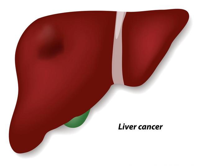 Nature综述：肝癌的治疗现状与未来