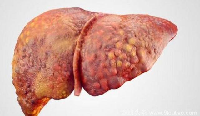 脂肪肝不用怕，做好预防和控制就不会变肝癌，3个要点需谨记