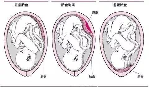 33岁女子怀孕34周，结果胎死腹中！医生：孩子本来可以活下来……