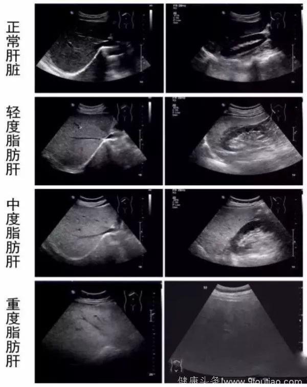 医学科普｜脂肪肝是怎样炼成的？