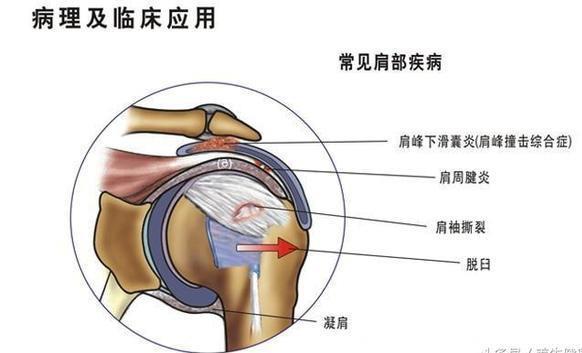 肩周炎别着急，学会这5个小动作，10分钟缓解肩周炎，拿走不谢！