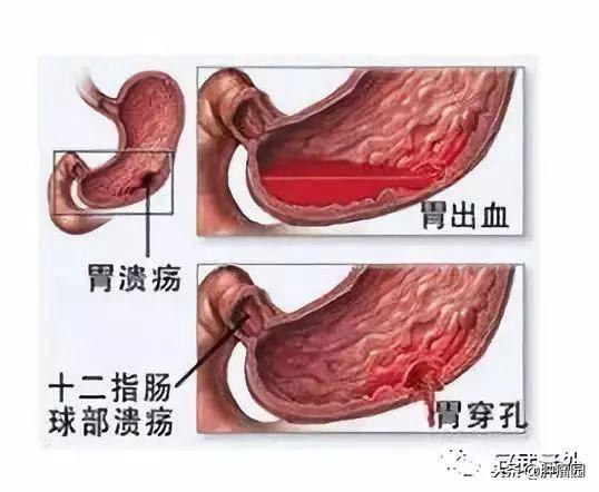 慢性胃病会演变为癌症吗？