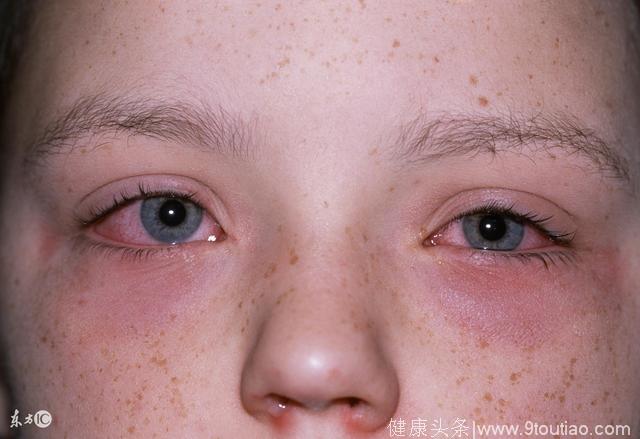 小孩皮肤红痒过敏怎么办？看看医生给的建议和小方法吧！