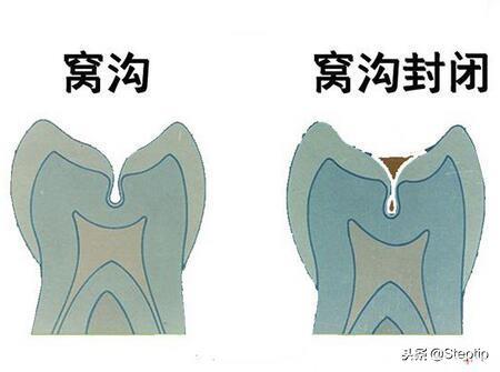孩子六龄牙以及牙缝填补“窝沟封闭”的最佳年龄时间段