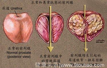 悄悄告诉你，家里这两样食物就可以治前列腺炎