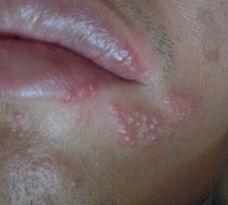 口腔部位的疱疹是怎么引起的