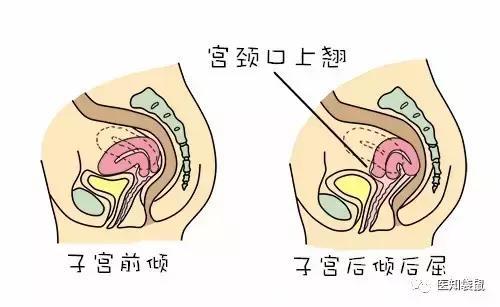 子宫前位、后位，女人哪种子宫最易受孕？