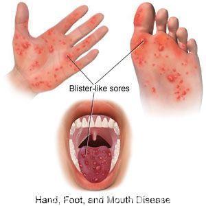 手足口、疱疹性咽峡炎卷土重来，发生这些情况要迅速就医
