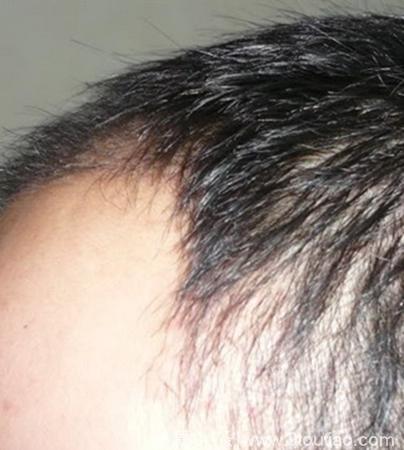 男性脂溢性脱发有哪些治疗方法