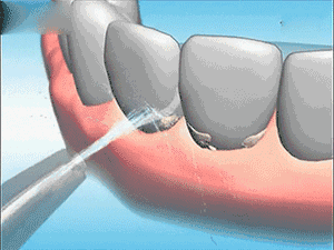 洗牙难受吗？为什么牙医总推荐我们洗牙？