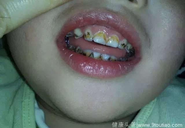 宝宝牙齿上长小黑点，到底有多可怕？怎么去除呢？