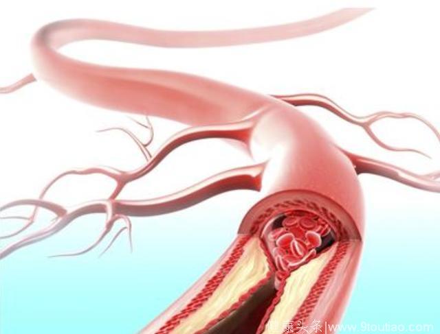 引起冠心病的5大原因，得了冠心病该如何调理