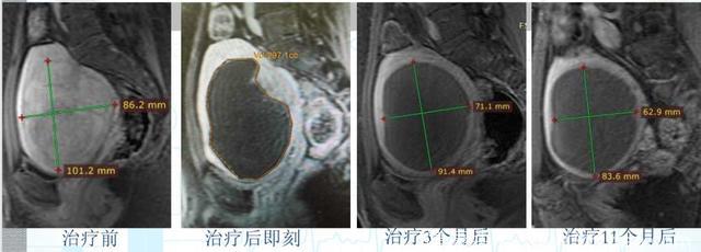 子宫肌瘤腺肌症消融治疗以后会发生什么样的变化