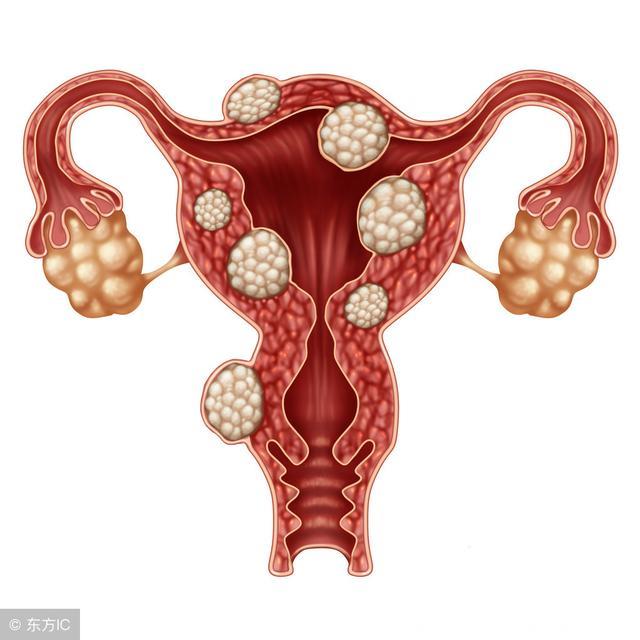 子宫肌瘤不可怕，及时治疗是关键？这3个治疗方法或能派上用场