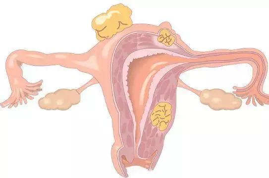 女性身体有5个症状说明子宫肌瘤来了，要注意