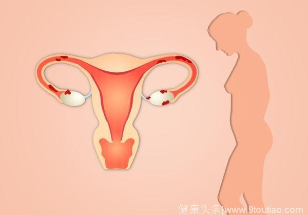 女性生育功能的杀手：子宫内膜异位症