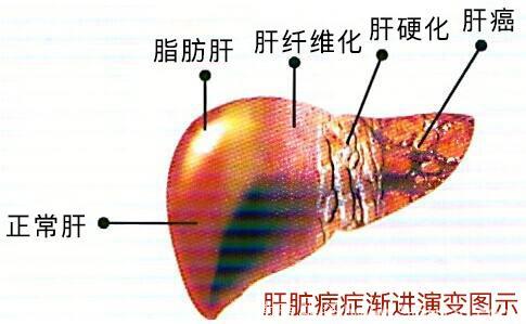 走路是治愈脂肪肝“最好”的方法！怎么走？