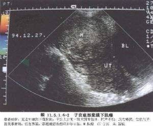 不开刀，子宫肌瘤该如何保守治疗？