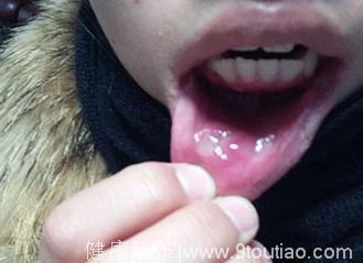 口腔疱疹引发孩子发烧不退有什么办法来缓解