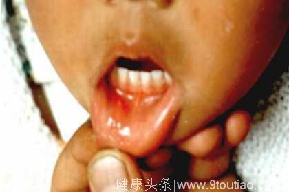 口腔疱疹引发孩子发烧不退有什么办法来缓解