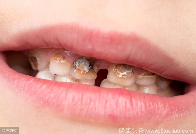 乳牙龋病的分类