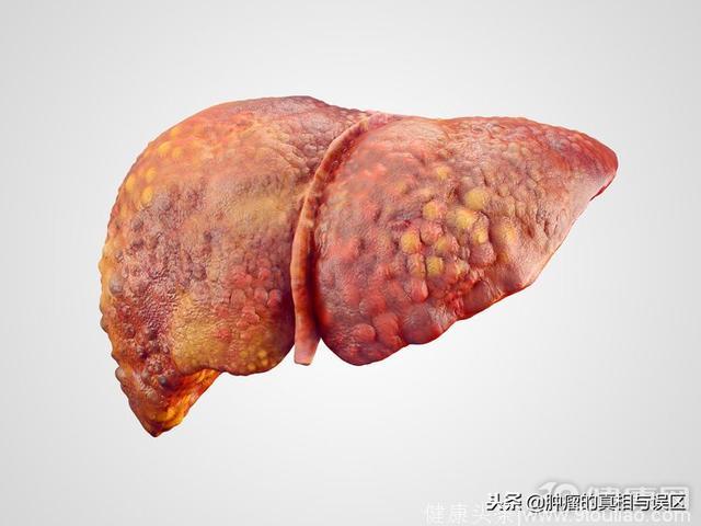 肝硬化是肝癌最后一步！任这3个诱因发展，肝“变硬”很正常